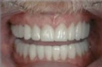 Veneers verdecken Zahnlcke