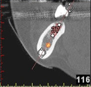 3D-Implantatplanung - Detailaufnahme 6