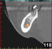 3D-Implantatplanung - Detailaufnahme 8