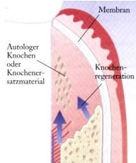 Zahnfleischtasche nach OP mit Knochenaufbau